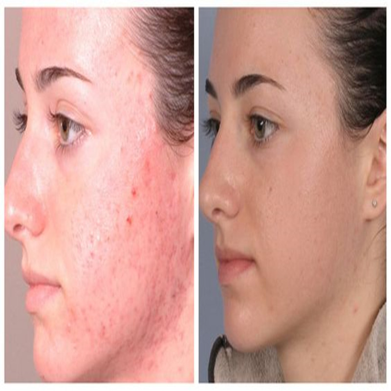 Díol te Microdermabrasion Diamond Peeling Monarcha Meaisín Díol Díol Díreach