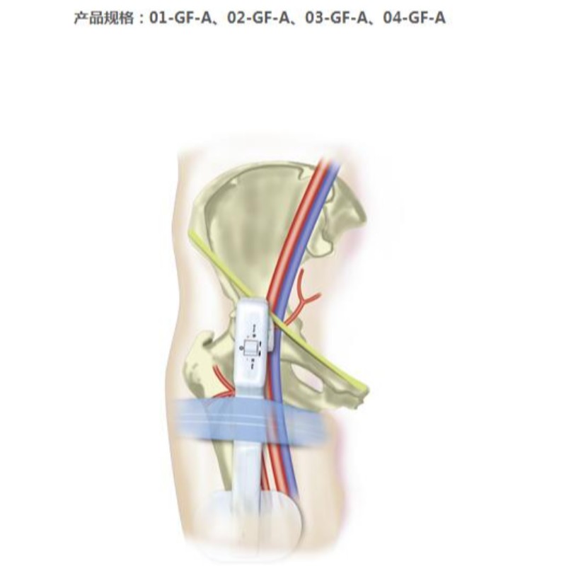 Goldfinger Electronic Femoral Hemostasis tihendusseade