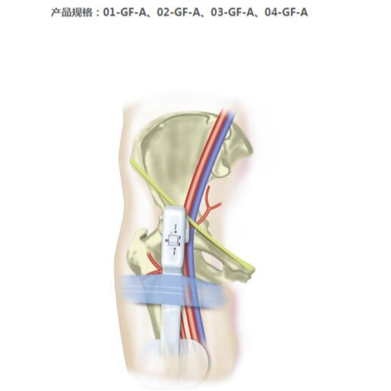 Goldfinger Electronic Femoral Hemostasis tihendusseade